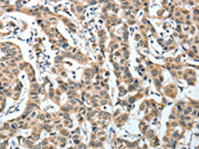 The image on the left is immunohistochemistry of paraffin-embedded Human breast cancer tissue using CSB-PA727952(IL1R1 Antibody) at dilution 1/25, on the right is treated with fusion protein. (Original magnification: ×200)