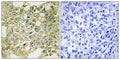 Immunohistochemical analysis of paraffin-embedded human breast carcinoma tissue using MYT1 (Phospho-Ser83) antibody (left)or the same antibody preincubated with blocking peptide (right).