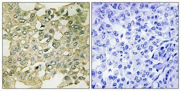 Immunohistochemical analysis of paraffin-embedded human breast carcinoma tissue using MYT1 (Phospho-Ser83) antibody (left)or the same antibody preincubated with blocking peptide (right).