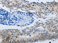 The image on the left is immunohistochemistry of paraffin-embedded Human colon cancer tissue using CSB-PA729577(MMP21 Antibody) at dilution 1/45, on the right is treated with synthetic peptide. (Original magnification: ×200)