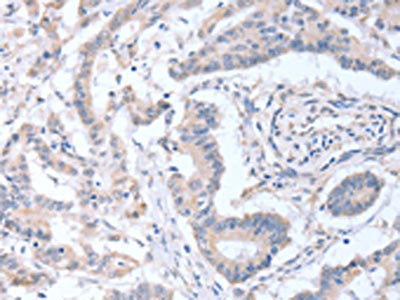 The image on the left is immunohistochemistry of paraffin-embedded Human colon cancer tissue using CSB-PA729731(ACOT9 Antibody) at dilution 1/15, on the right is treated with fusion protein. (Original magnification: ×200)