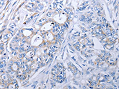 The image on the left is immunohistochemistry of paraffin-embedded Human colon cancer tissue using CSB-PA729886(ALDH1A1/ALDH1A2/ALDH1A3 Antibody) at dilution 1/40, on the right is treated with fusion protein. (Original magnification: ×200)