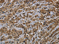 The image on the left is immunohistochemistry of paraffin-embedded Human breast cancer tissue using CSB-PA729928(FTO Antibody) at dilution 1/60, on the right is treated with fusion protein. (Original magnification: ×200)