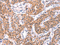 The image on the left is immunohistochemistry of paraffin-embedded Human lung cancer tissue using CSB-PA729954(SERPINA5 Antibody) at dilution 1/40, on the right is treated with fusion protein. (Original magnification: ×200)