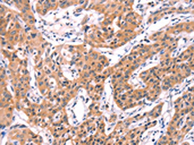 The image on the left is immunohistochemistry of paraffin-embedded Human lung cancer tissue using CSB-PA729954(SERPINA5 Antibody) at dilution 1/40, on the right is treated with fusion protein. (Original magnification: ×200)
