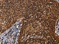 The image on the left is immunohistochemistry of paraffin-embedded Human cervical cancer tissue using CSB-PA730045(FASTKD5 Antibody) at dilution 1/40, on the right is treated with fusion protein. (Original magnification: ×200)