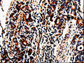 The image on the left is immunohistochemistry of paraffin-embedded Human stomach cancer tissue using CSB-PA732422(ACSBG2 Antibody) at dilution 1/60, on the right is treated with fusion protein. (Original magnification: ×200)
