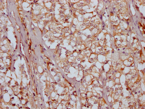 IHC image of CSB-PA732918LA01HU diluted at 1:200 and staining in paraffin-embedded human adrenal gland tissue performed on a Leica BondTM system. After dewaxing and hydration, antigen retrieval was mediated by high pressure in a citrate buffer (pH 6.0). Section was blocked with 10% normal goat serum 30min at RT. Then primary antibody (1% BSA) was incubated at 4°C overnight. The primary is detected by a Goat anti-rabbit IgG labeled by HRP and visualized using 0.05% DAB.