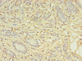 Immunohistochemistry of paraffin-embedded human breast cancer using CSB-PA732978LA01HU at dilution of 1:100