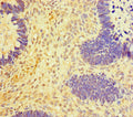Immunohistochemistry of paraffin-embedded human ovarian cancer using CSB-PA736198LA01HU at dilution of 1:100