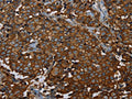 The image on the left is immunohistochemistry of paraffin-embedded Human breast cancer tissue using CSB-PA736786(ERBB4 Antibody) at dilution 1/40, on the right is treated with fusion protein. (Original magnification: ×200)