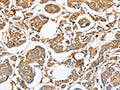The image on the left is immunohistochemistry of paraffin-embedded Human breast cancer tissue using CSB-PA737797(CAPG Antibody) at dilution 1/35, on the right is treated with fusion protein. (Original magnification: ×200)