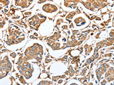 The image on the left is immunohistochemistry of paraffin-embedded Human breast cancer tissue using CSB-PA737797(CAPG Antibody) at dilution 1/35, on the right is treated with fusion protein. (Original magnification: ×200)