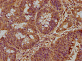 IHC image of CSB-PA744134LA01HU diluted at 1:500 and staining in paraffin-embedded human colon cancer performed on a Leica BondTM system. After dewaxing and hydration, antigen retrieval was mediated by high pressure in a citrate buffer (pH 6.0). Section was blocked with 10% normal goat serum 30min at RT. Then primary antibody (1% BSA) was incubated at 4&deg;C overnight. The primary is detected by a biotinylated secondary antibody and visualized using an HRP conjugated SP system.