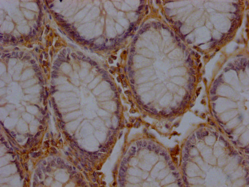 IHC image of CSB-PA744137LA11HU diluted at 1:200 and staining in paraffin-embedded human colon cancer performed on a Leica BondTM system. After dewaxing and hydration, antigen retrieval was mediated by high pressure in a citrate buffer (pH 6.0). Section was blocked with 10% normal goat serum 30min at RT. Then primary antibody (1% BSA) was incubated at 4°C overnight. The primary is detected by a Goat anti-rabbit polymer IgG labeled by HRP and visualized using 0.05% DAB.