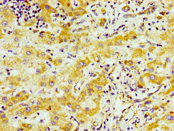 Immunohistochemistry of paraffin-embedded human liver cancer using CSB-PA745330LA01HU at dilution of 1:100