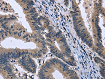 The image on the left is immunohistochemistry of paraffin-embedded Human colon cancer tissue using CSB-PA746124(KCNJ11 Antibody) at dilution 1/40, on the right is treated with fusion protein. (Original magnification: ×200)