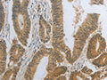 The image on the left is immunohistochemistry of paraffin-embedded Human colon cancer tissue using CSB-PA747689(DNAJC7 Antibody) at dilution 1/25, on the right is treated with fusion protein. (Original magnification: ×200)