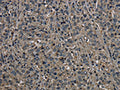 The image on the left is immunohistochemistry of paraffin-embedded Human liver cancer tissue using CSB-PA748508(GSTO1 Antibody) at dilution 1/60, on the right is treated with fusion protein. (Original magnification: ×200)