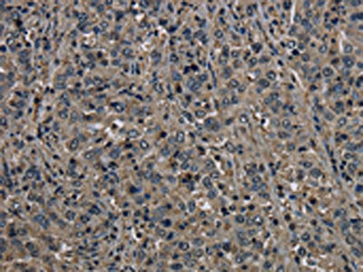 The image on the left is immunohistochemistry of paraffin-embedded Human liver cancer tissue using CSB-PA748508(GSTO1 Antibody) at dilution 1/60, on the right is treated with fusion protein. (Original magnification: ×200)