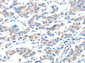 The image on the left is immunohistochemistry of paraffin-embedded Human breast cancer tissue using CSB-PA748751(XBP1 Antibody) at dilution 1/70, on the right is treated with fusion protein. (Original magnification: ×200)