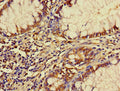 Immunohistochemistry of paraffin-embedded human colon cancer using CSB-PA751062LA01HU at dilution of 1:100