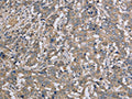The image on the left is immunohistochemistry of paraffin-embedded Human liver cancer tissue using CSB-PA756613(DTNB Antibody) at dilution 1/50, on the right is treated with fusion protein. (Original magnification: ×200)