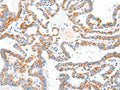 The image on the left is immunohistochemistry of paraffin-embedded Human thyroid cancer tissue using CSB-PA759135(CASP7 Antibody) at dilution 1/25, on the right is treated with fusion protein. (Original magnification: ×200)