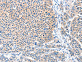 The image on the left is immunohistochemistry of paraffin-embedded Human liver cancer tissue using CSB-PA760706(ADAM20 Antibody) at dilution 1/50, on the right is treated with fusion protein. (Original magnification: ×200)