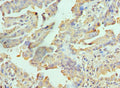 Immunohistochemistry of paraffin-embedded human lung cancer using CSB-PA761396ESR1HU at dilution of 1:100