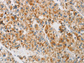 The image on the left is immunohistochemistry of paraffin-embedded Human liver cancer tissue using CSB-PA762941(NGB Antibody) at dilution 1/20, on the right is treated with fusion protein. (Original magnification: ×200)