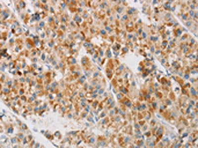 The image on the left is immunohistochemistry of paraffin-embedded Human liver cancer tissue using CSB-PA762941(NGB Antibody) at dilution 1/20, on the right is treated with fusion protein. (Original magnification: ×200)