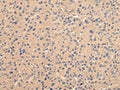 The image on the left is immunohistochemistry of paraffin-embedded Human liver cancer tissue using CSB-PA763132(BMP4 Antibody) at dilution 1/25, on the right is treated with fusion protein. (Original magnification: ×200)