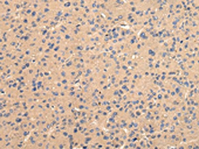 The image on the left is immunohistochemistry of paraffin-embedded Human liver cancer tissue using CSB-PA763132(BMP4 Antibody) at dilution 1/25, on the right is treated with fusion protein. (Original magnification: ×200)