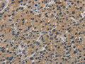 The image is immunohistochemistry of paraffin-embedded Human liver cancer tissue using CSB-PA763138(CASP9 Antibody) at dilution 1/60. (Original magnification: ×200)