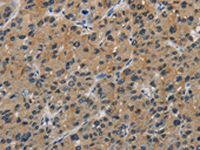 The image is immunohistochemistry of paraffin-embedded Human liver cancer tissue using CSB-PA763138(CASP9 Antibody) at dilution 1/60. (Original magnification: ×200)
