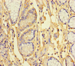 Immunohistochemistry of paraffin-embedded human gastric cancer using CSB-PA768761LA01HU at dilution of 1:100