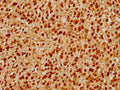 IHC image of CSB-PA769774LA01HU diluted at 1:500 and staining in paraffin-embedded human glioma performed on a Leica BondTM system. After dewaxing and hydration, antigen retrieval was mediated by high pressure in a citrate buffer (pH 6.0). Section was blocked with 10% normal goat serum 30min at RT. Then primary antibody (1% BSA) was incubated at 4°C overnight. The primary is detected by a biotinylated secondary antibody and visualized using an HRP conjugated SP system.