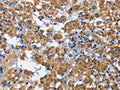 The image on the left is immunohistochemistry of paraffin-embedded Human thyroid cancer tissue using CSB-PA773682(CDK5RAP3 Antibody) at dilution 1/60, on the right is treated with fusion protein. (Original magnification: ×200)