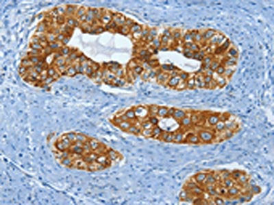 The image on the left is immunohistochemistry of paraffin-embedded Human cervical cancer tissue using CSB-PA774709(KRT81 Antibody) at dilution 1/15, on the right is treated with fusion protein. (Original magnification: ×200)