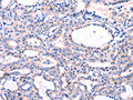 The image on the left is immunohistochemistry of paraffin-embedded Human thyroid cancer tissue using CSB-PA774733(DUSP12 Antibody) at dilution 1/77, on the right is treated with fusion protein. (Original magnification: ×200)