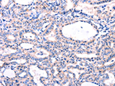 The image on the left is immunohistochemistry of paraffin-embedded Human thyroid cancer tissue using CSB-PA774733(DUSP12 Antibody) at dilution 1/77, on the right is treated with fusion protein. (Original magnification: ×200)