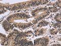 The image on the left is immunohistochemistry of paraffin-embedded Human colon cancer tissue using CSB-PA775661(FAM107A Antibody) at dilution 1/30, on the right is treated with fusion protein. (Original magnification: ×200)