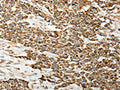The image on the left is immunohistochemistry of paraffin-embedded Human esophagus cancer tissue using CSB-PA775739(SELE Antibody) at dilution 1/30, on the right is treated with fusion protein. (Original magnification: ×200)