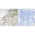 Immunohistochemistry analysis of paraffin-embedded human breast carcinoma tissue, using TAF13 antibody.