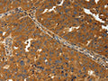 The image on the left is immunohistochemistry of paraffin-embedded Human ovarian cancer tissue using CSB-PA776176(AMD1 Antibody) at dilution 1/30, on the right is treated with synthetic peptide. (Original magnification: ×200)