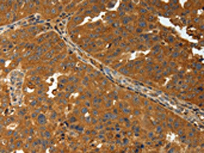 The image on the left is immunohistochemistry of paraffin-embedded Human ovarian cancer tissue using CSB-PA776176(AMD1 Antibody) at dilution 1/30, on the right is treated with synthetic peptide. (Original magnification: ×200)