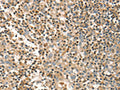 The image on the left is immunohistochemistry of paraffin-embedded Human tonsil tissue using CSB-PA776528(FMNL1 Antibody) at dilution 1/20, on the right is treated with fusion protein. (Original magnification: ×200)