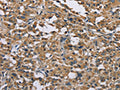 The image on the left is immunohistochemistry of paraffin-embedded Human thyroid cancer tissue using CSB-PA776568(GAB1 Antibody) at dilution 1/40, on the right is treated with fusion protein. (Original magnification: ×200)