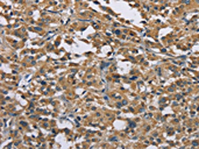 The image on the left is immunohistochemistry of paraffin-embedded Human thyroid cancer tissue using CSB-PA776568(GAB1 Antibody) at dilution 1/40, on the right is treated with fusion protein. (Original magnification: ×200)
